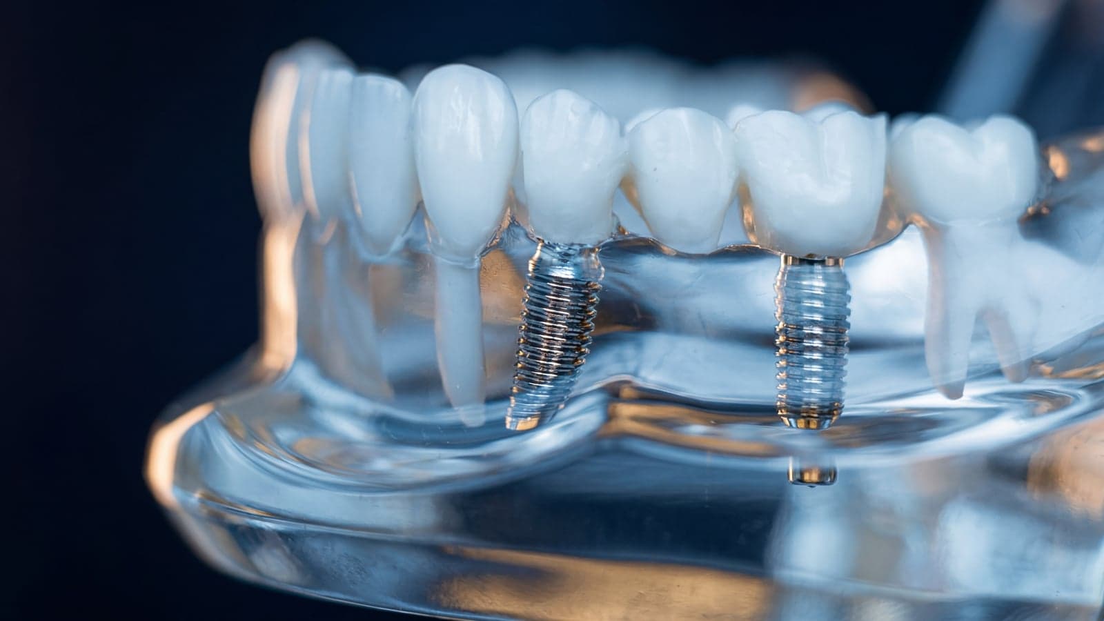 Zahnimplantate vom Spezialisten in Frankfurt